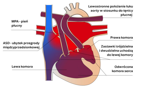 Dwunapływowa lewa komora serca