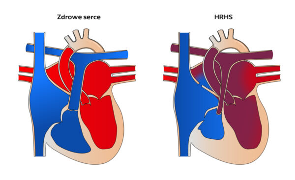 Zespół niedorozwoju prawego serca