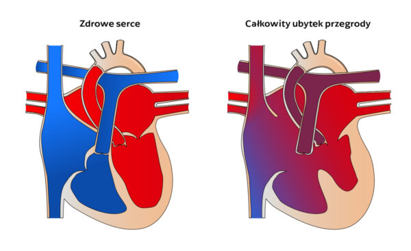 Całkowity ubytek przegrody